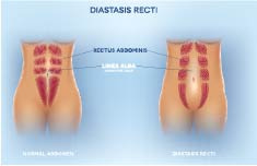 Diastasis-Recti