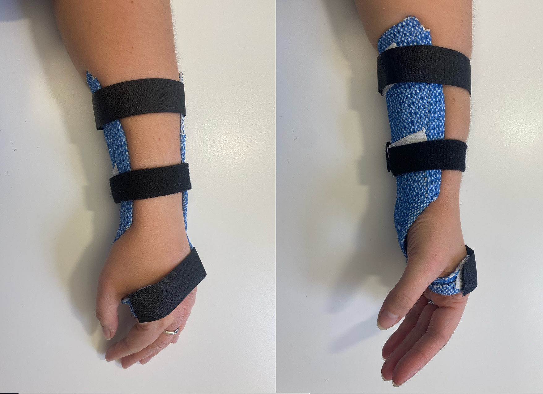 Hand and Wrist injuries from Skiing and Snowboarding Six Physio